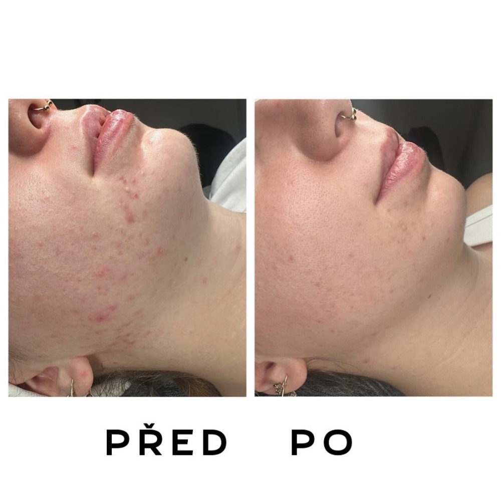 Ošetření problematické pleti - před a po, Plzeň