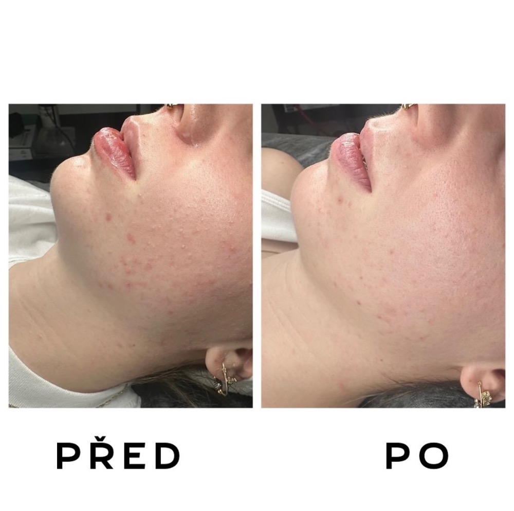 Kosmetika- akné Plzeň