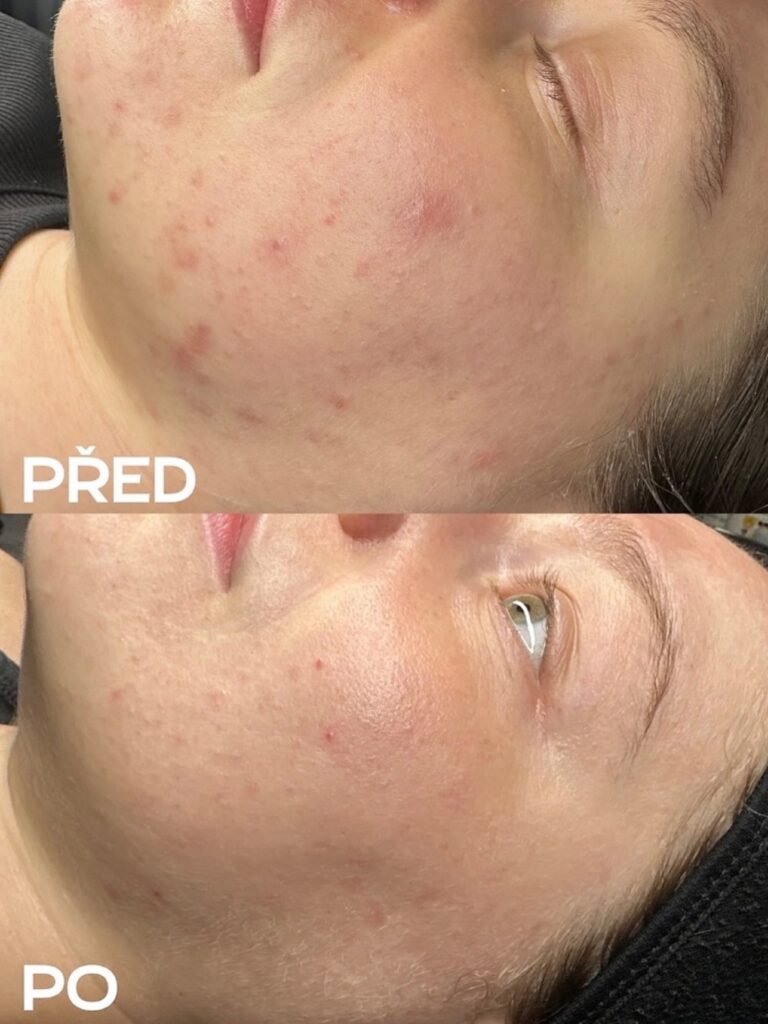 Ošetření aknozní pleti v Plzni