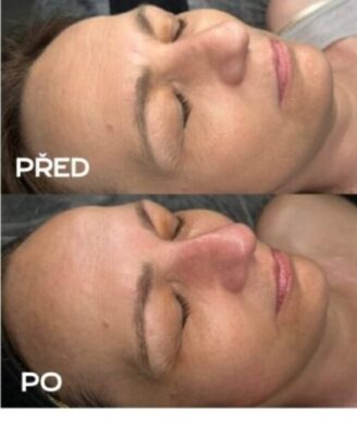 Omlazující ošetření na vrásky Plzeň