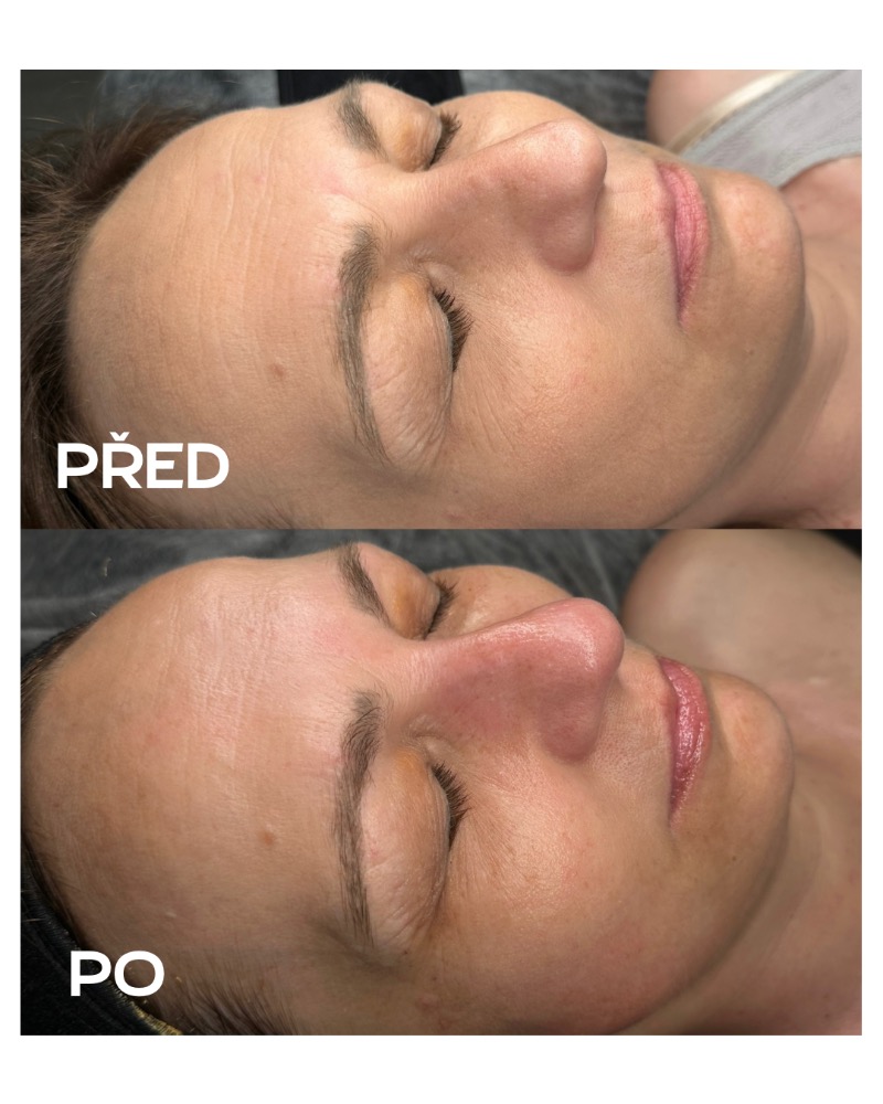 Omlazující ošetření na vrásky Plzeň