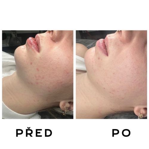 Kosmetika- akné Plzeň