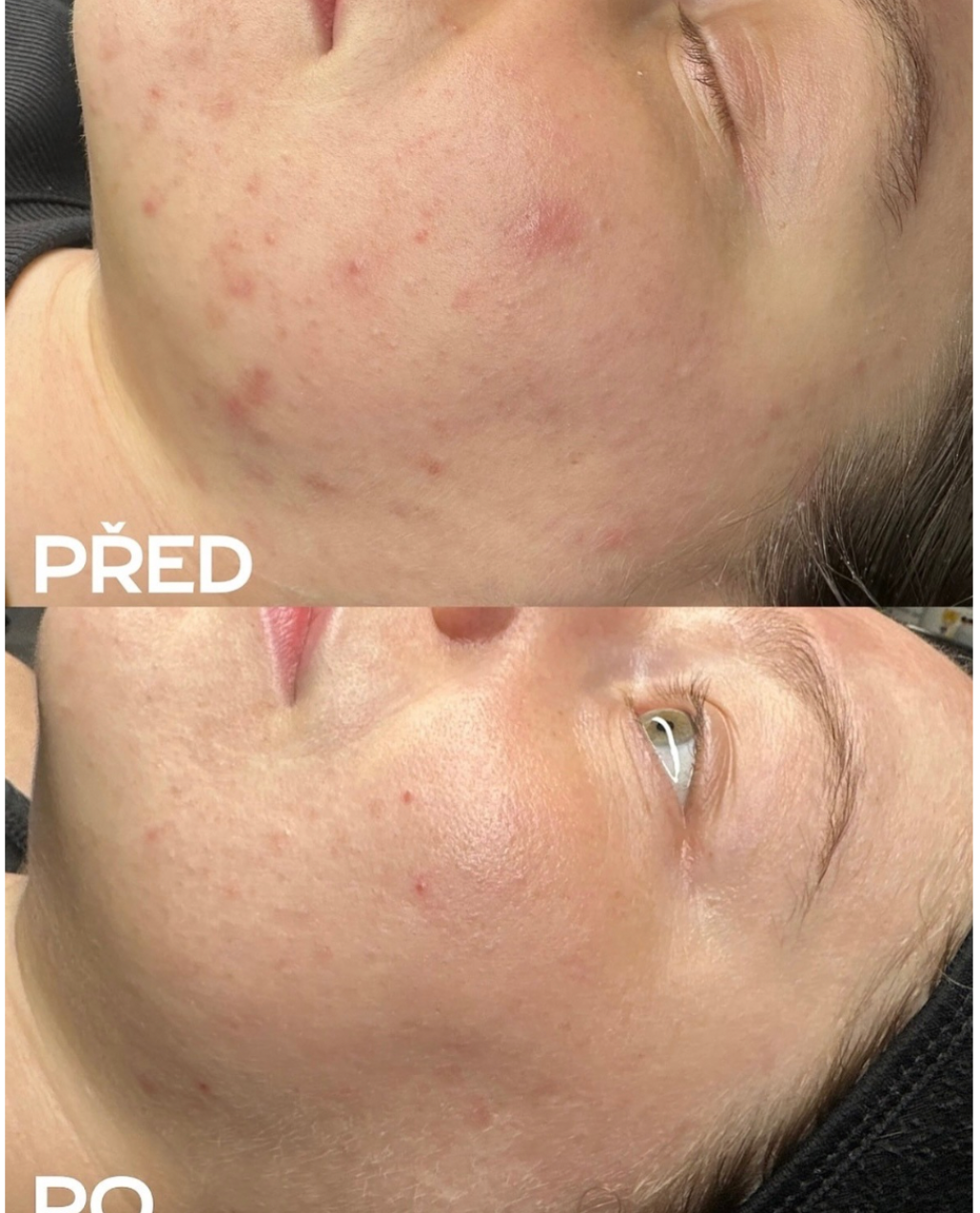 Ošetření problematické pleti - před a po, Plzeň